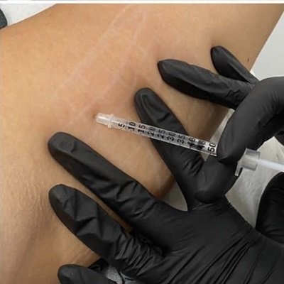 FAT DISSOLVING INJECTIONS AT DNA AESTHETICS CLINIC IN CANADA WATER, SOUTH EAST LONDON