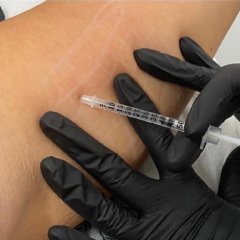 Fat Dissolving Injections at best aesthetics salon in Canada Water, SE London