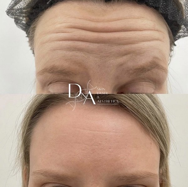 Anti-wrinkle injections at DNA Aesthetics Clinic in South East London