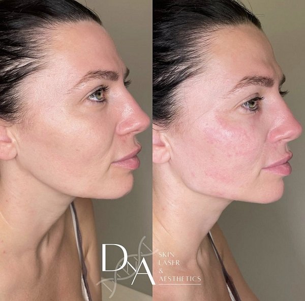 Dermal fillers  at DNA Aesthetics Clinic in South East London