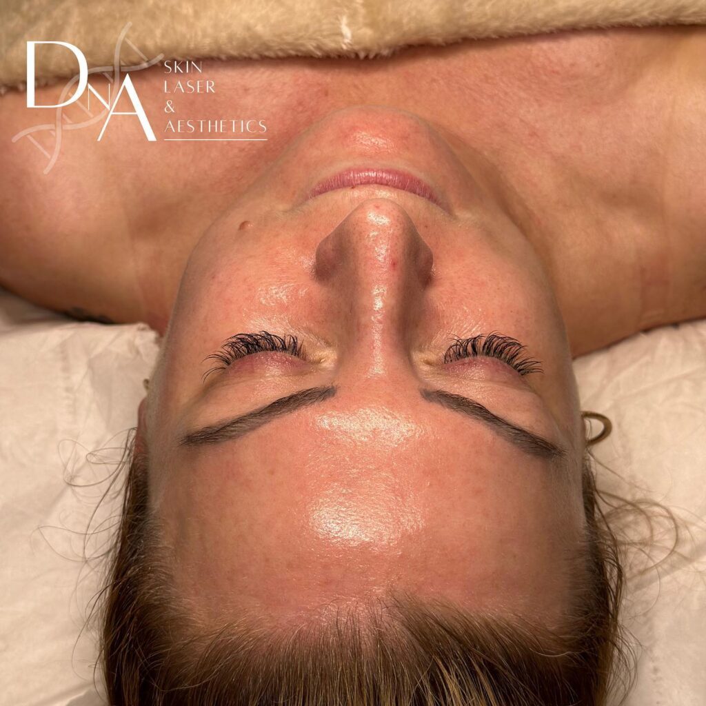 Fire and Ice Facial At DNA Aesthetics Clininc In Canada Water