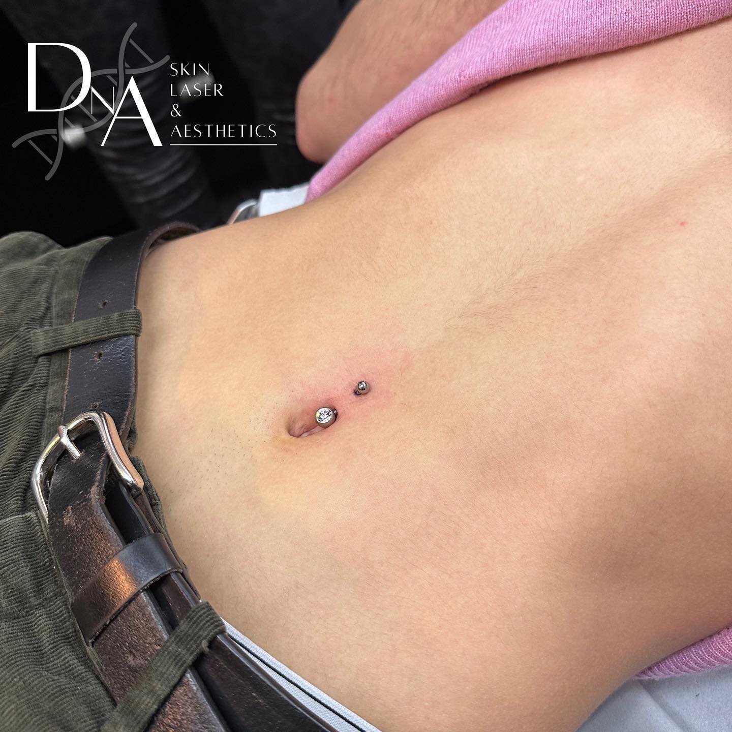 Naval Piercings At Top Aesthetics Clinic In South London