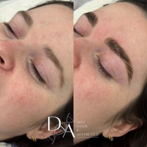 Brow Services at DNA Aesthetics Clinic in Canada Water
