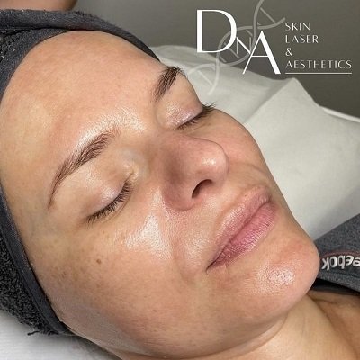 Skin Booster & Anti-Wrinkle Treatment Offer