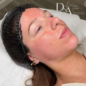Microneedling at DNA Aesthetics Clinic in London