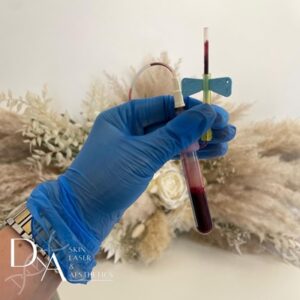 PRP Therapy at DNA Aesthetics Clinic