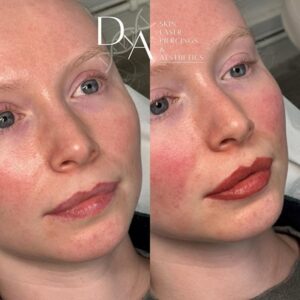 Lip Blush at DNA Aesthetics Clinic in South East London