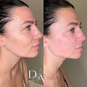 Jawline-and-cheek-filler-nasiolabial-folds-undereye-skin-boosters-anti-wrinkle-injections