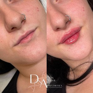 LIP-FILLERS-AT-DNA-AESTHETICS-CLINIC-IN-CANADA-WATER